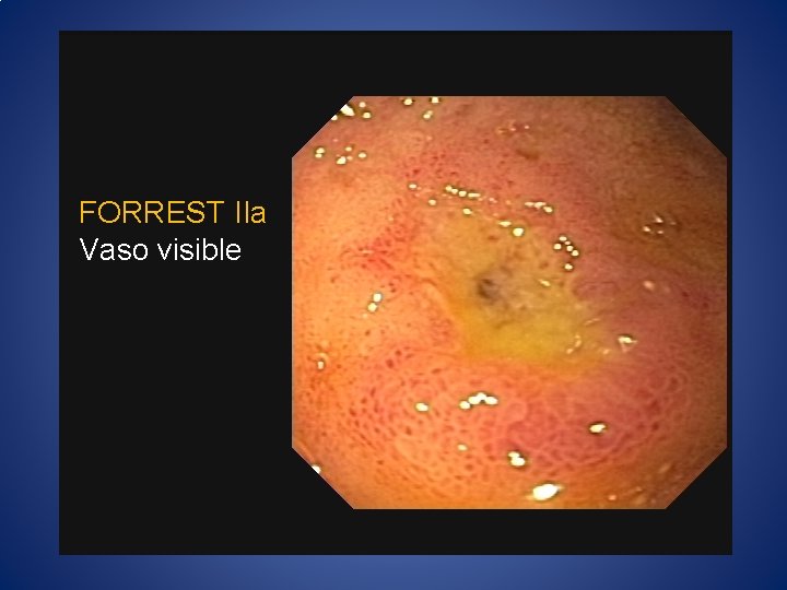 FORREST IIa Vaso visible 