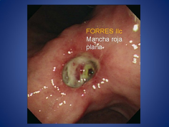 FORRES IIc Mancha roja plana 
