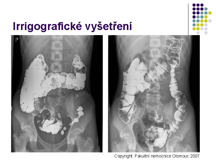 Irrigografické vyšetření Copyright: Fakultní nemocnice Olomouc 2007 