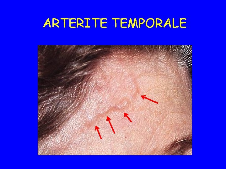 ARTERITE TEMPORALE 