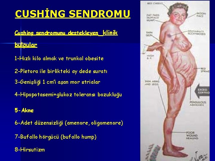 CUSHİNG SENDROMU Cushing sendromunu destekleyen klinik bulgular 1 -Hızlı kilo almak ve trunkal obesite