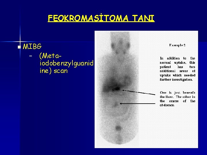 FEOKROMASİTOMA TANI n MIBG – (Metaiodobenzylguanid ine) scan 