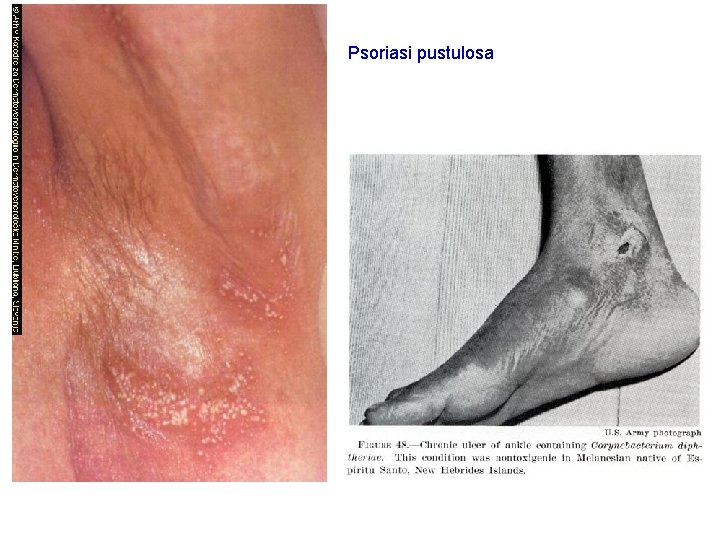 Psoriasi pustulosa 