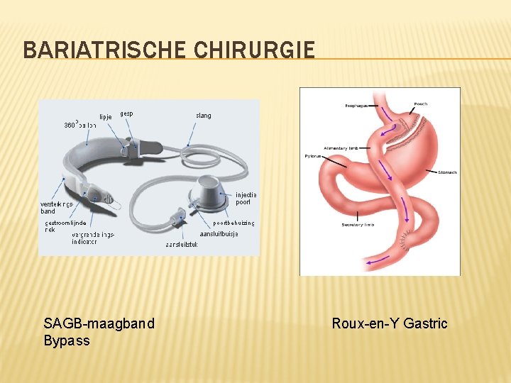 BARIATRISCHE CHIRURGIE SAGB-maagband Bypass Roux-en-Y Gastric 