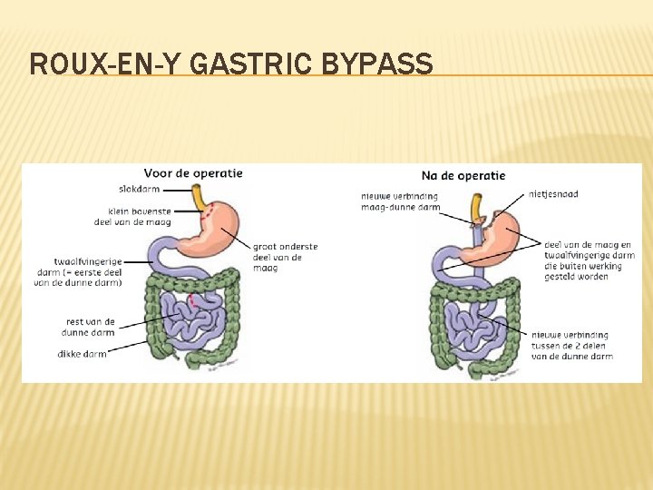 ROUX-EN-Y GASTRIC BYPASS 
