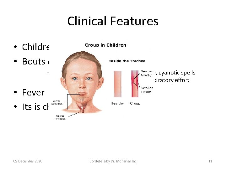 Clinical Features • Children are mostly affected • Bouts of paroxysmal coughing – Air