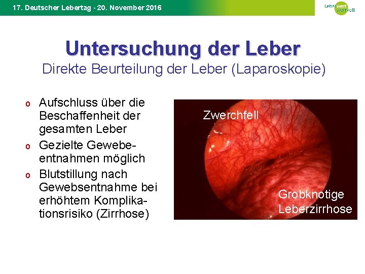 17. Deutscher Lebertag - 20. November 2016 Untersuchung der Leber Direkte Beurteilung der Leber