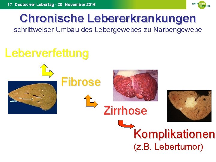 17. Deutscher Lebertag - 20. November 2016 Chronische Lebererkrankungen schrittweiser Umbau des Lebergewebes zu