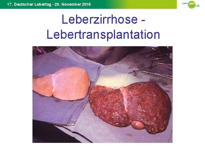 17. Deutscher Lebertag - 20. November 2016 Leberzirrhose Lebertransplantation 