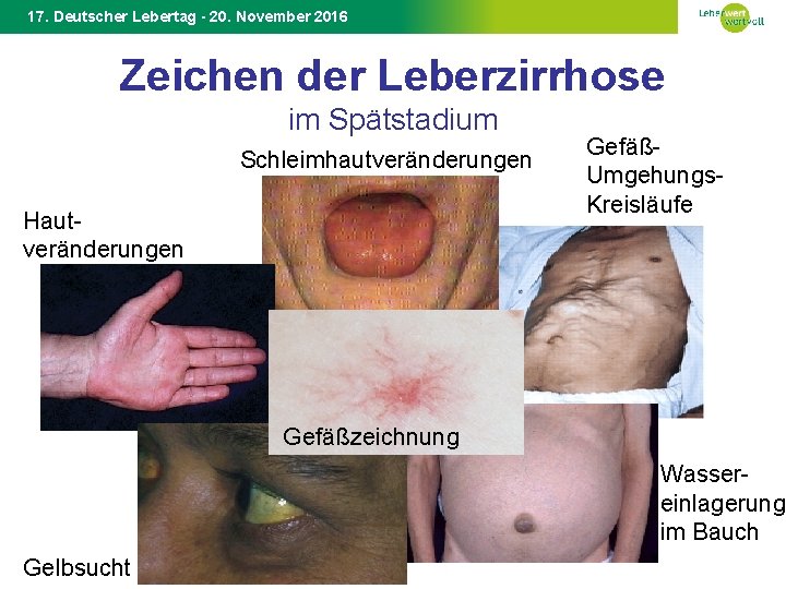 17. Deutscher Lebertag - 20. November 2016 Zeichen der Leberzirrhose im Spätstadium Schleimhautveränderungen Hautveränderungen