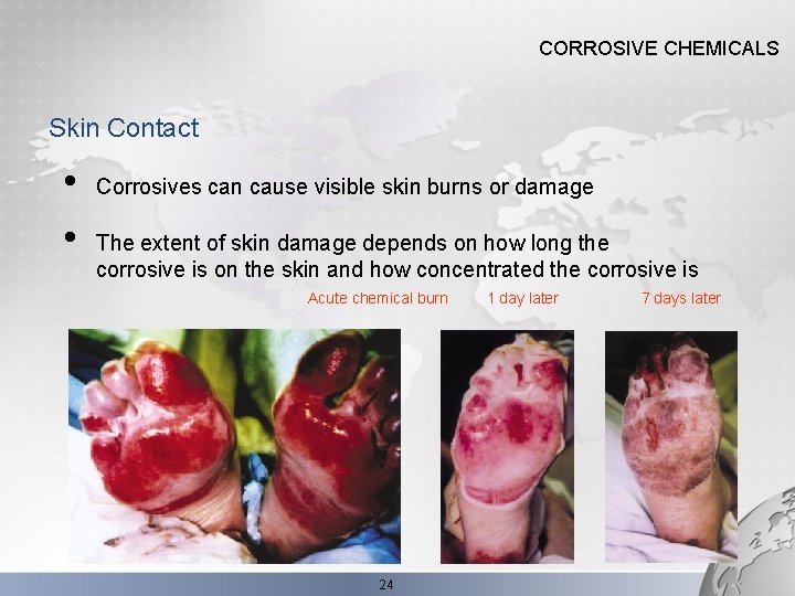 CORROSIVE CHEMICALS Skin Contact • • Corrosives can cause visible skin burns or damage