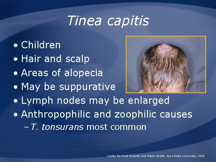 Tinea capitis • Children • Hair and scalp • Areas of alopecia • May