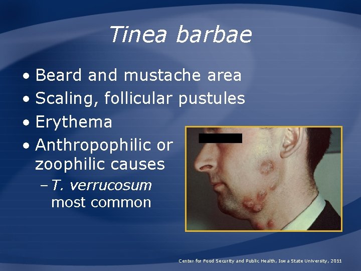 Tinea barbae • Beard and mustache area • Scaling, follicular pustules • Erythema •