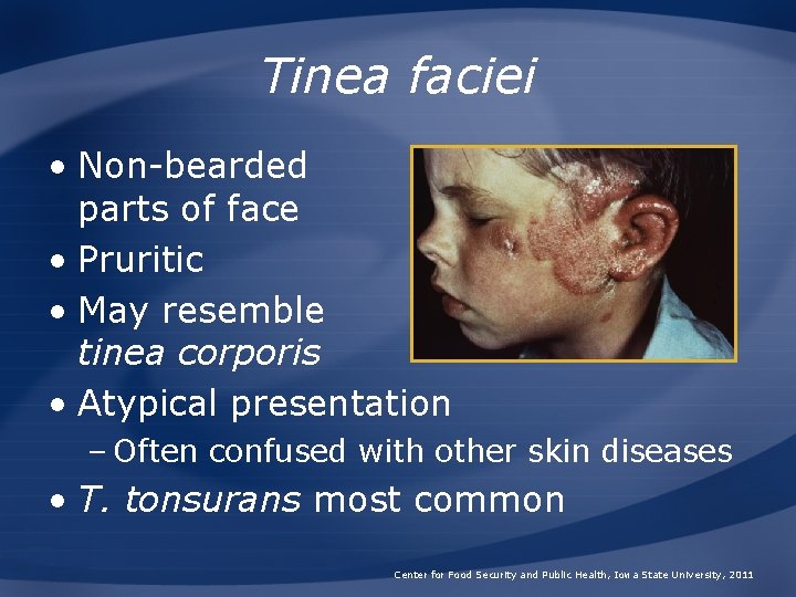 Tinea faciei • Non-bearded parts of face • Pruritic • May resemble tinea corporis