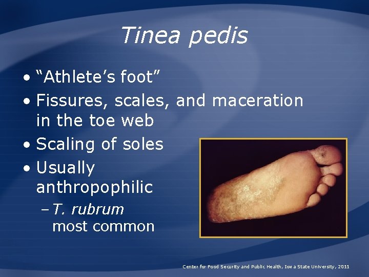 Tinea pedis • “Athlete’s foot” • Fissures, scales, and maceration in the toe web