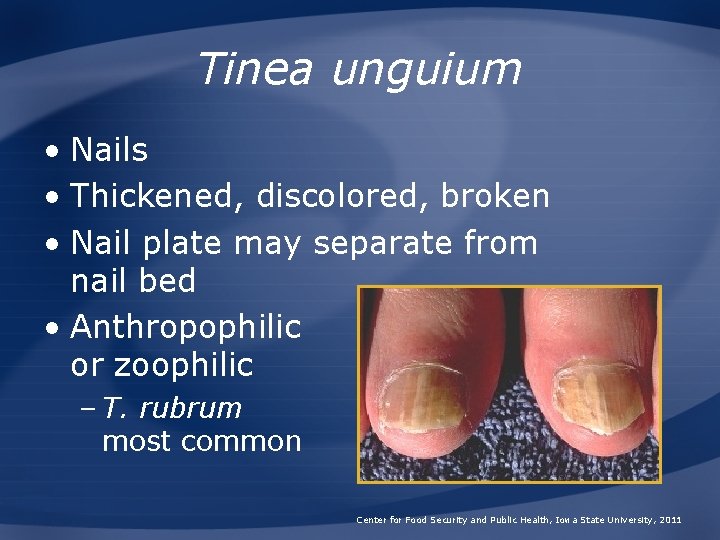 Tinea unguium • Nails • Thickened, discolored, broken • Nail plate may separate from