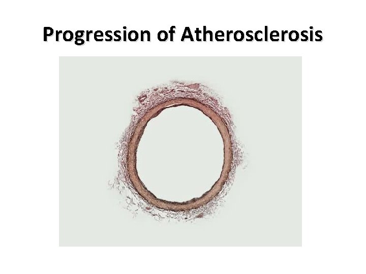 Progression of Atherosclerosis 