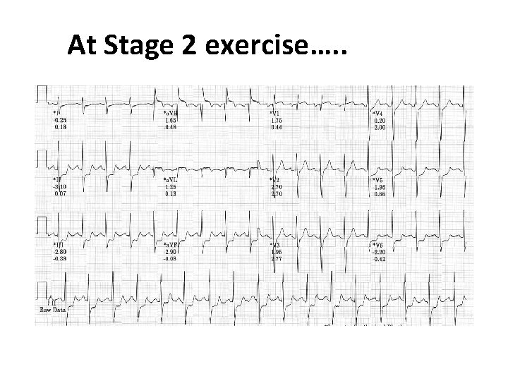 At Stage 2 exercise…. . 