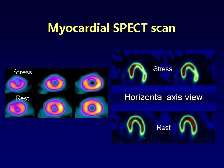 Myocardial SPECT scan Stress Rest 