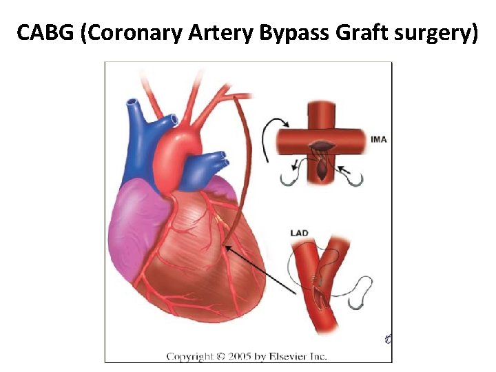 CABG (Coronary Artery Bypass Graft surgery) 