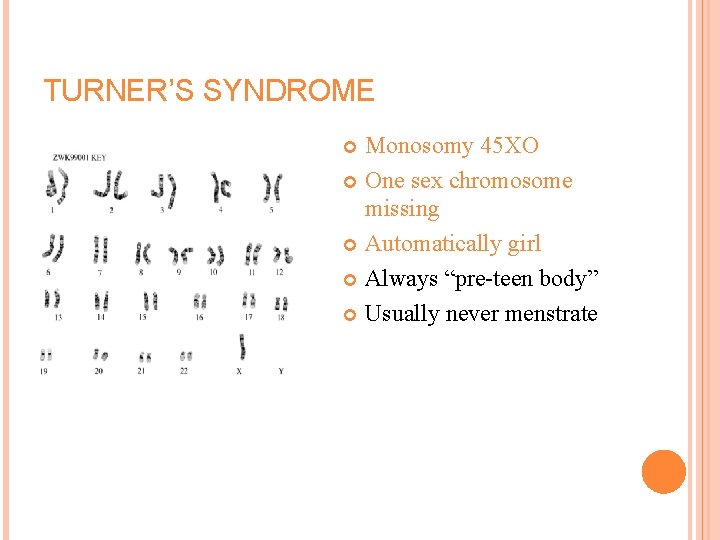 TURNER’S SYNDROME Monosomy 45 XO One sex chromosome missing Automatically girl Always “pre-teen body”
