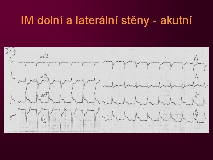 IM dolní a laterální stěny - akutní 