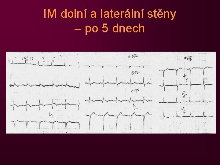 IM dolní a laterální stěny – po 5 dnech 