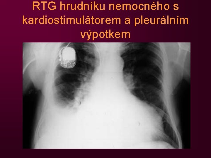 RTG hrudníku nemocného s kardiostimulátorem a pleurálním výpotkem 