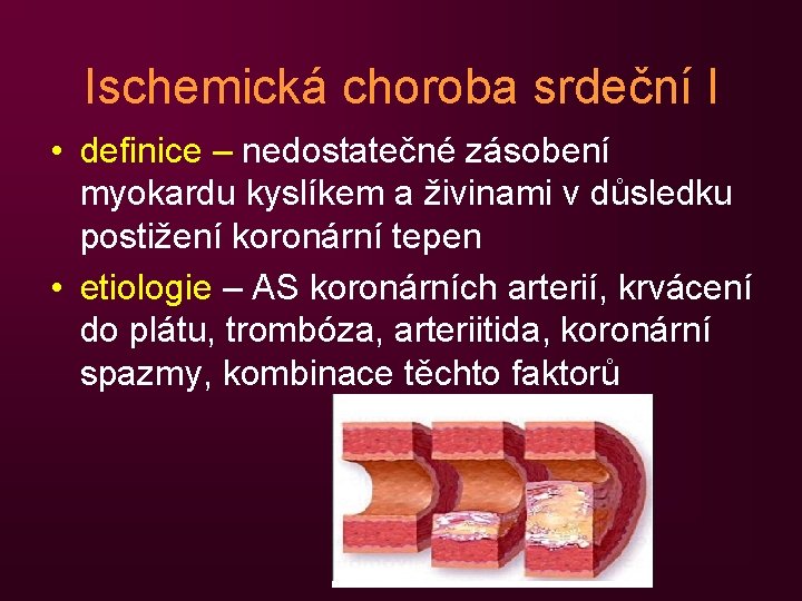 Ischemická choroba srdeční I • definice – nedostatečné zásobení myokardu kyslíkem a živinami v