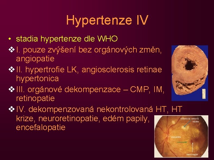 Hypertenze IV • stadia hypertenze dle WHO v I. pouze zvýšení bez orgánových změn,