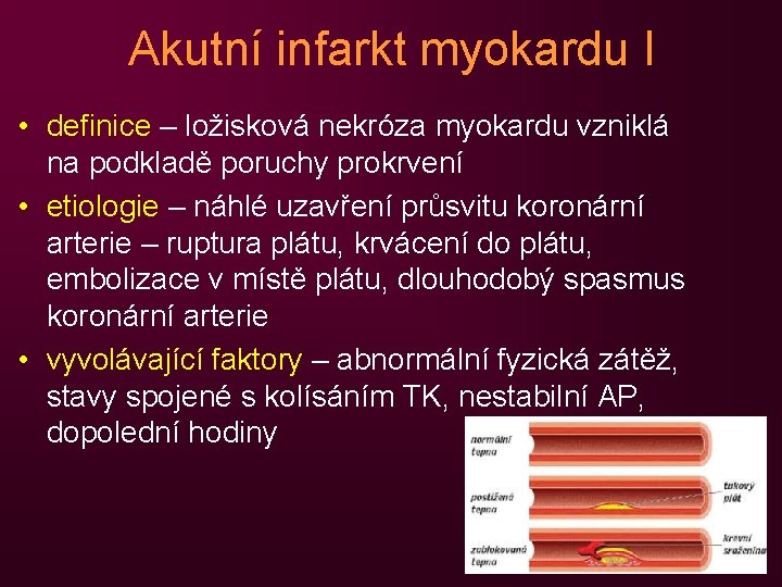 Akutní infarkt myokardu I • definice – ložisková nekróza myokardu vzniklá na podkladě poruchy