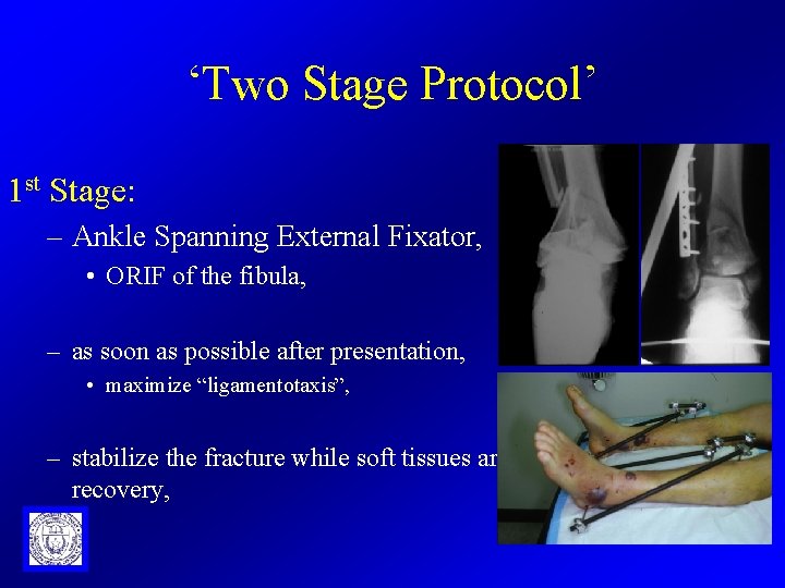 ‘Two Stage Protocol’ 1 st Stage: – Ankle Spanning External Fixator, • ORIF of