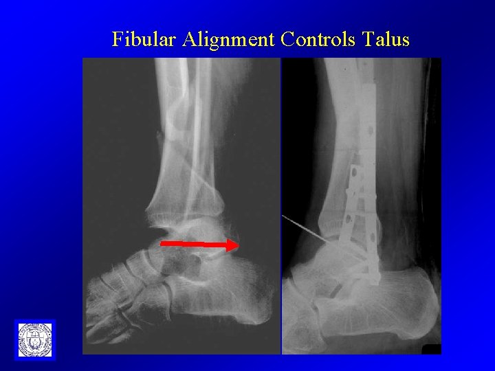Fibular Alignment Controls Talus 