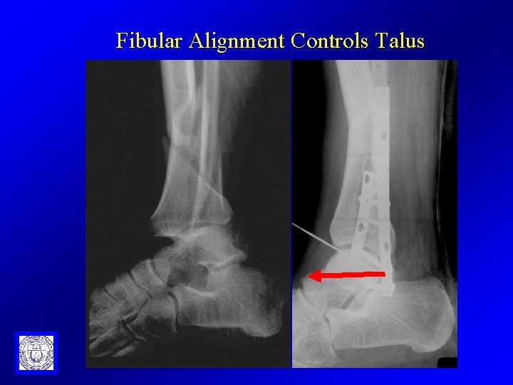 Fibular Alignment Controls Talus 