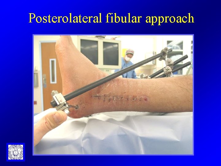 Posterolateral fibular approach 