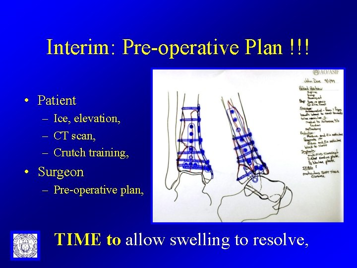 Interim: Pre-operative Plan !!! • Patient – Ice, elevation, – CT scan, – Crutch