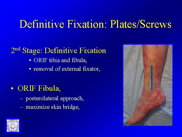 Definitive Fixation: Plates/Screws 2 nd Stage: Definitive Fixation • ORIF tibia and fibula, •