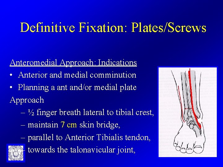 Definitive Fixation: Plates/Screws Anteromedial Approach: Indications • Anterior and medial comminution • Planning a