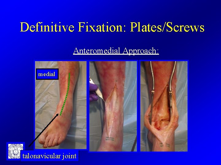 Definitive Fixation: Plates/Screws Anteromedial Approach: medial talonavicular joint 