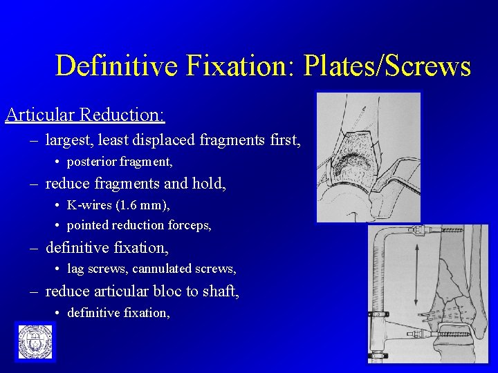 Definitive Fixation: Plates/Screws Articular Reduction: – largest, least displaced fragments first, • posterior fragment,