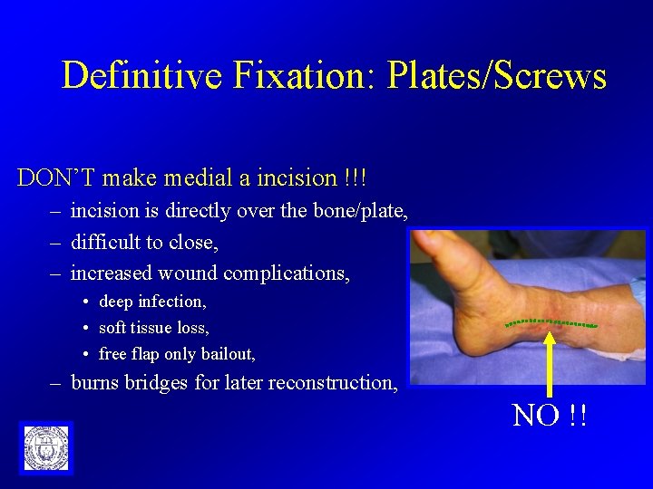 Definitive Fixation: Plates/Screws DON’T make medial a incision !!! – incision is directly over