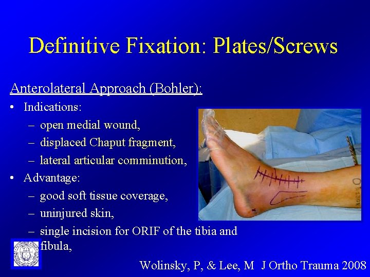 Definitive Fixation: Plates/Screws Anterolateral Approach (Bohler): • Indications: – open medial wound, – displaced