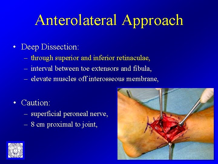 Anterolateral Approach • Deep Dissection: – through superior and inferior retinaculae, – interval between