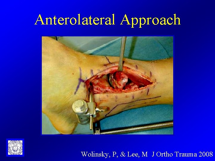 Anterolateral Approach Wolinsky, P, & Lee, M J Ortho Trauma 2008 
