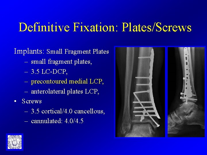Definitive Fixation: Plates/Screws Implants: Small Fragment Plates – small fragment plates, – 3. 5