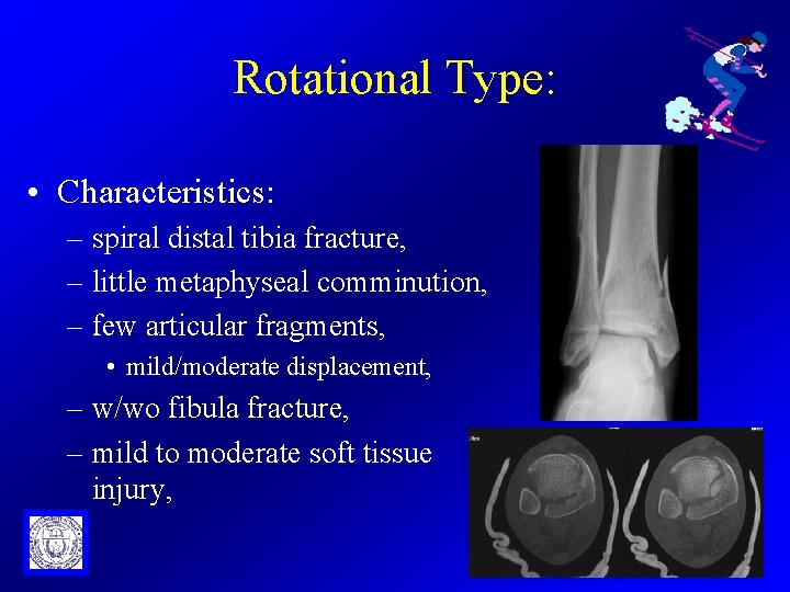 Rotational Type: • Characteristics: – spiral distal tibia fracture, – little metaphyseal comminution, –