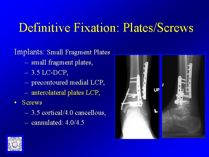 Definitive Fixation: Plates/Screws Implants: Small Fragment Plates – small fragment plates, – 3. 5