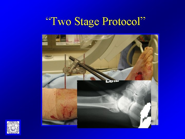“Two Stage Protocol” 