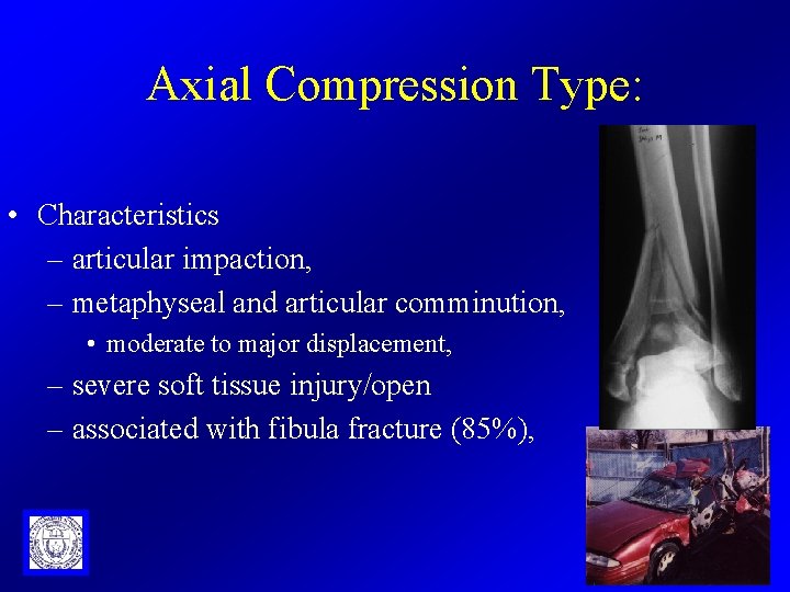 Axial Compression Type: • Characteristics – articular impaction, – metaphyseal and articular comminution, •
