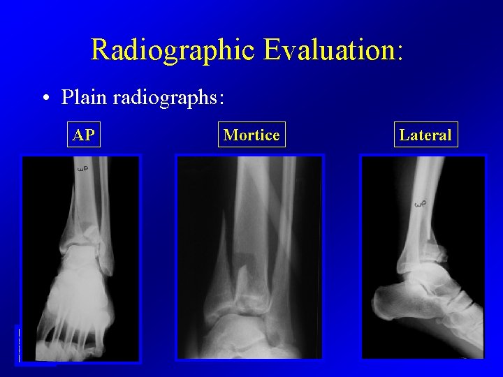 Radiographic Evaluation: • Plain radiographs: AP Mortice Lateral 